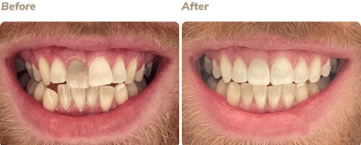 Before and after Invisalign result 1