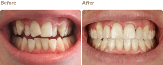 Before and after Invisalign result 2