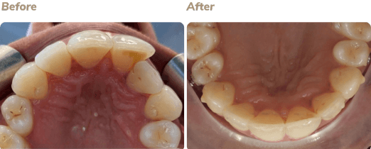 Before and after Invisalign result 3