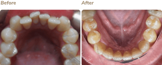 Before and after Invisalign result 4